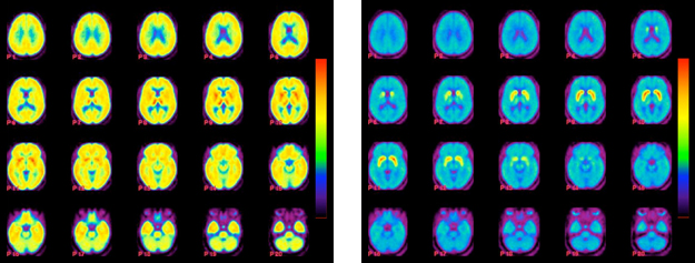 PET Scans